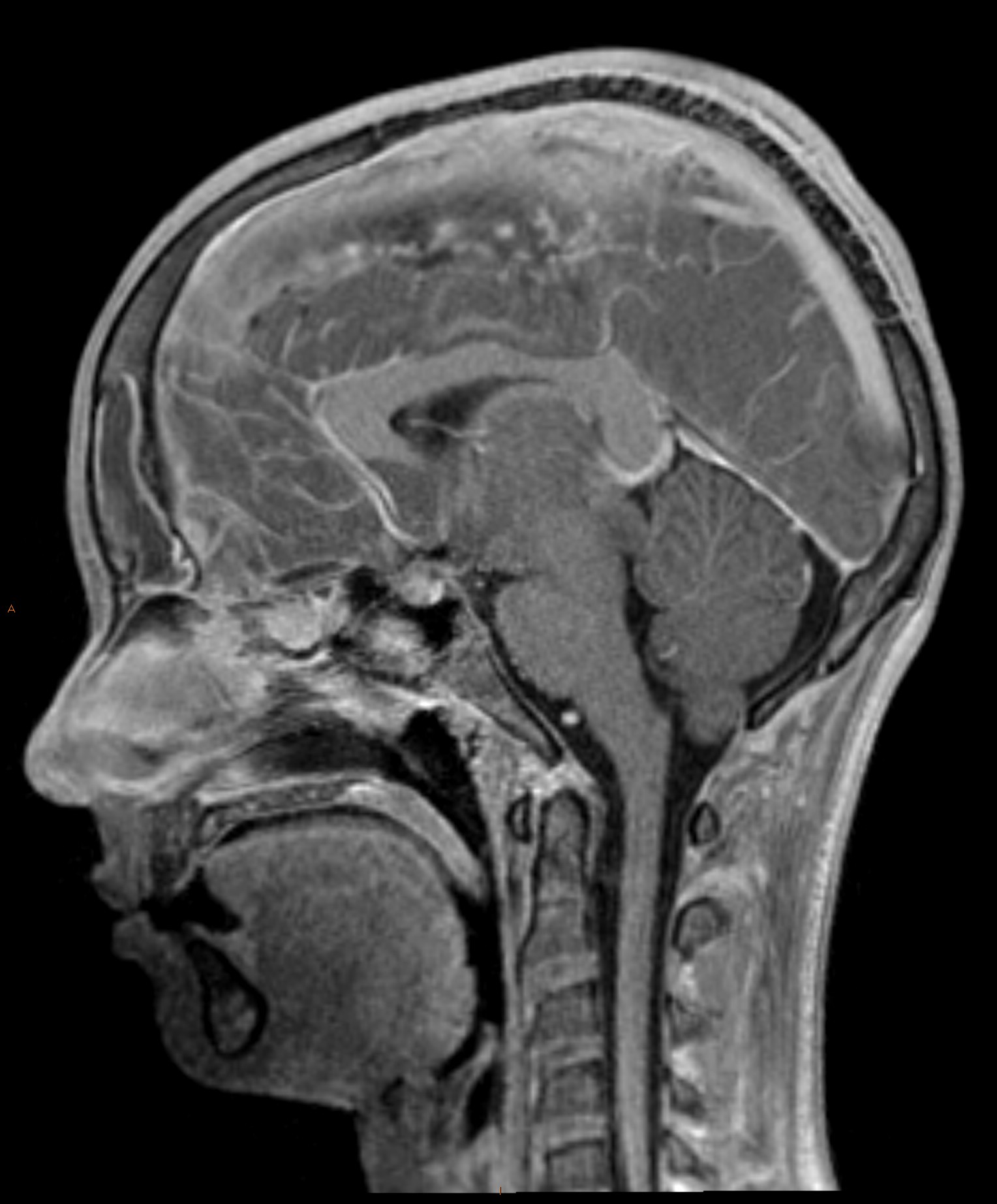 Subdural empyema and frontal abscess complicating frontal sinusitis ...