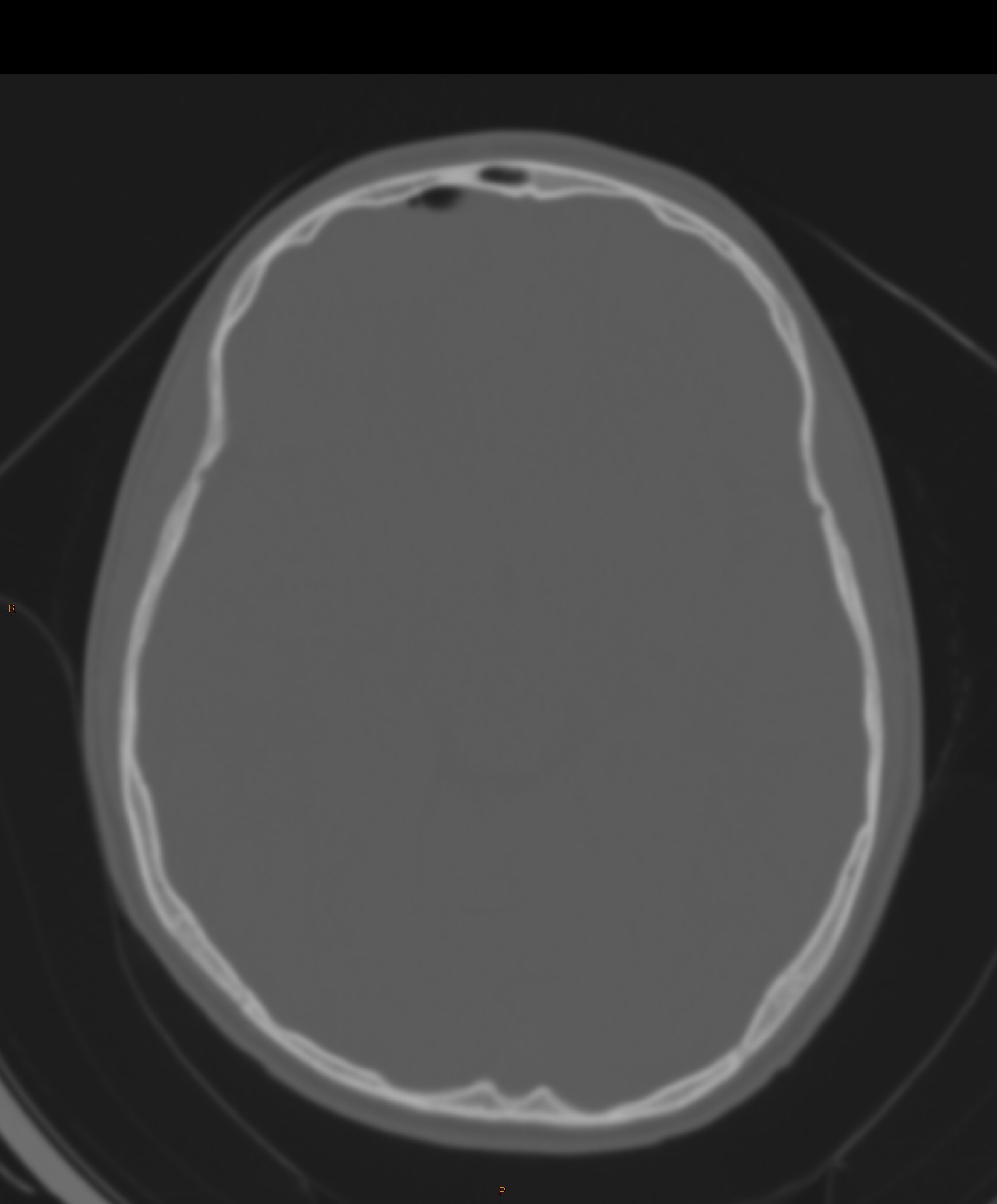 Epidural abscess complicating frontal sinusitis | Image | Radiopaedia.org