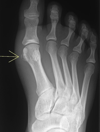 Acute calcific periarthritis | Radiology Reference Article ...