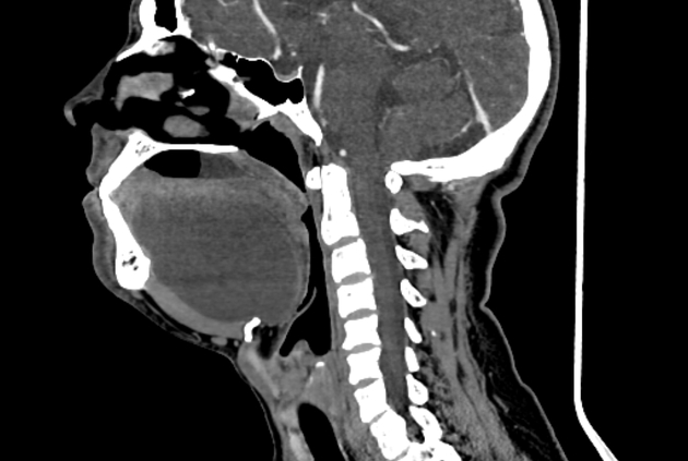 Floor Of The Mouth Cystic Lesion Radiology Case