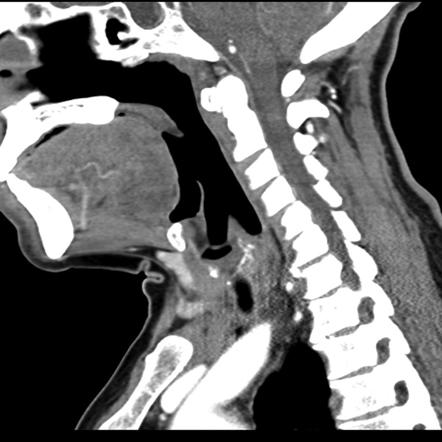 Ectopic thyroid | Image | Radiopaedia.org