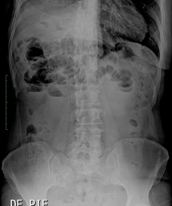 Gallstone ileus | Image | Radiopaedia.org