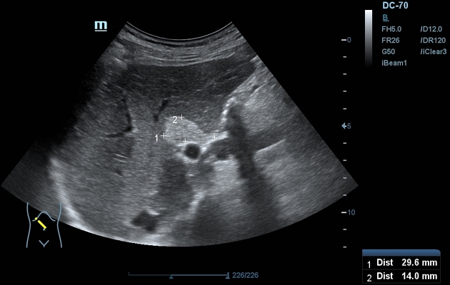 Focal Hepatic Steatosis Radiology Case Radiopaedia Org