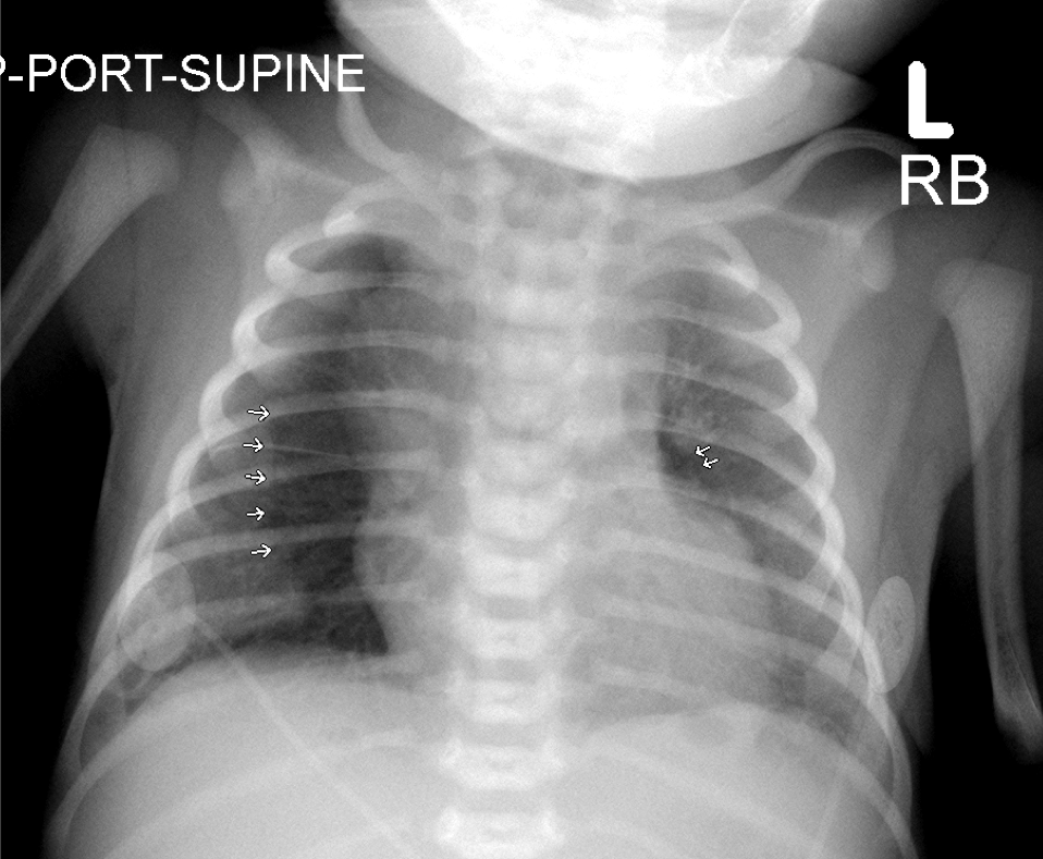 Neonatal pneumothorax secondary to meconium aspiration | Image ...