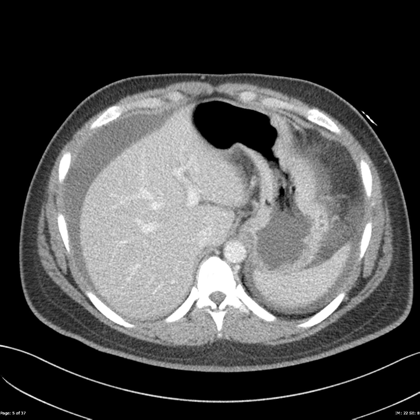 Intraperitoneal bladder rupture | Image | Radiopaedia.org