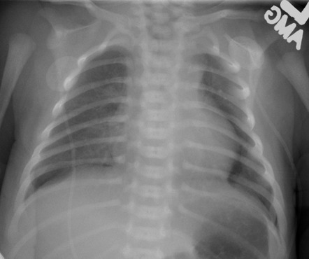 Neonatal Spontaneous Pneumothorax | Image | Radiopaedia.org