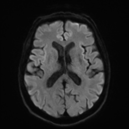 Alzheimer's disease | Image | Radiopaedia.org