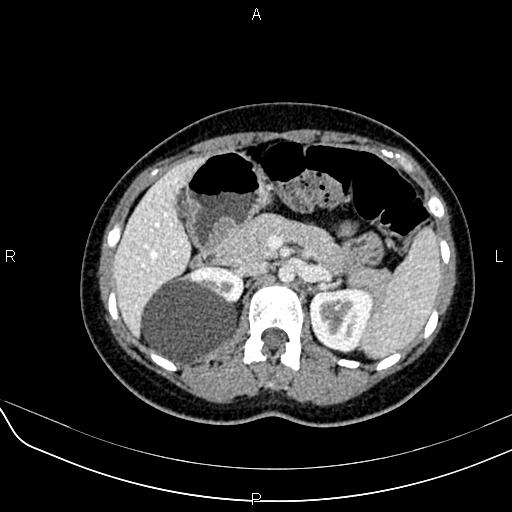 Nutcracker Syndrome Image