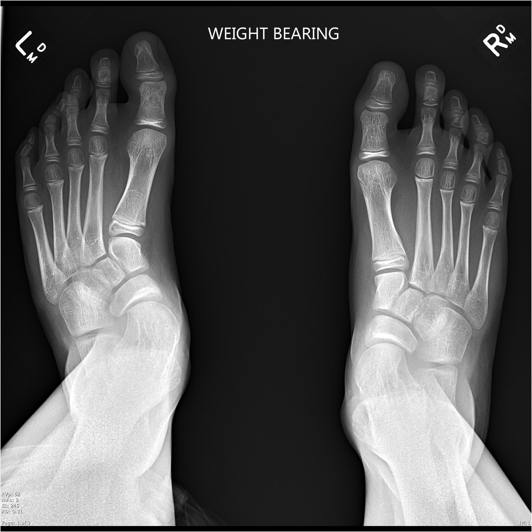 Skew foot | Image | Radiopaedia.org