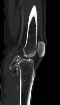 Calcified hematoma - popliteal fossa | Image | Radiopaedia.org