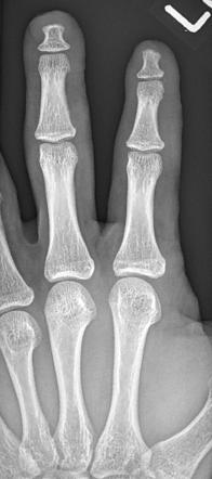 Acro-osteolysis | Radiology Reference Article | Radiopaedia.org