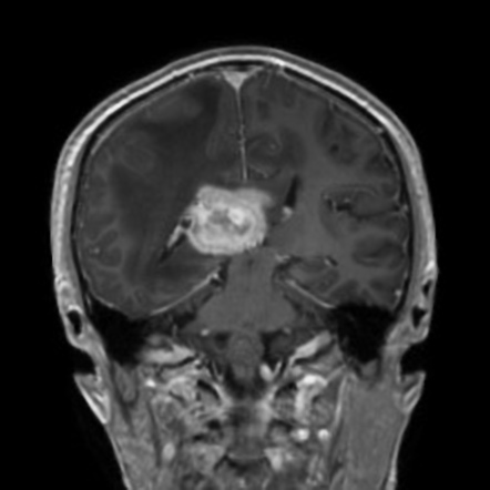 Primary CNS lymphoma (PCNSL) | Image | Radiopaedia.org