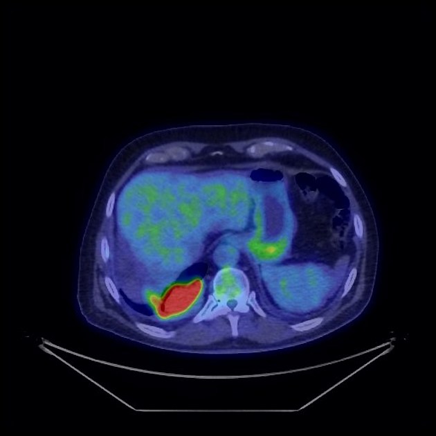 Mesothelioma | Radiology Reference Article | Radiopaedia.org