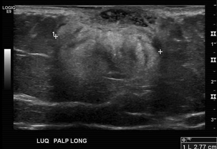 Dermatofibrosarcoma protuberans | Image | Radiopaedia.org