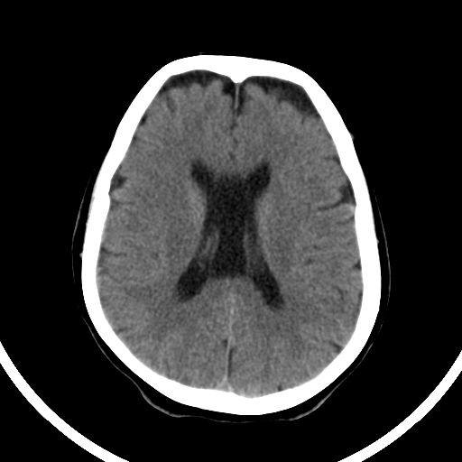 Cavum Septum Pellucidum Et Vergae Radiology Case 