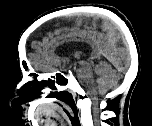 Cavum Septum Pellucidum Et Vergae | Image | Radiopaedia.org