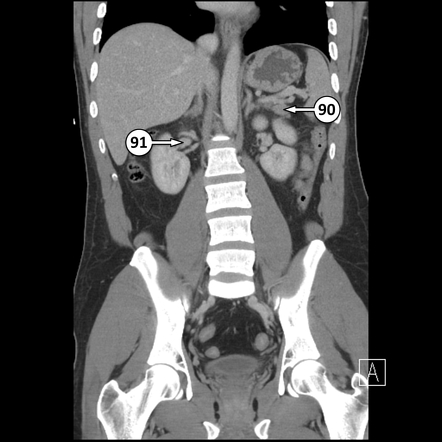 Renal vein | Radiology Reference Article | Radiopaedia.org