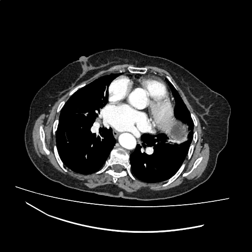 Cardiac hydatid disease | Image | Radiopaedia.org