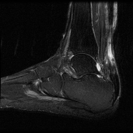 Achilles tendon tear | Radiology Case | Radiopaedia.org