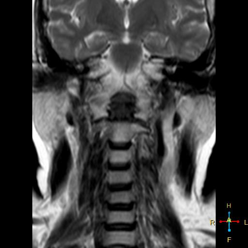 Rheumatoid Arthritis Of Cervical Spine Image 7969