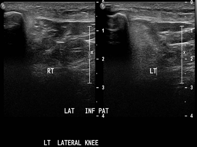 Hoffa's fat pad impingement syndrome (ultrasound) | Image | Radiopaedia.org