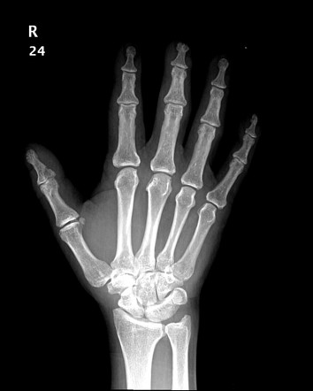 Lunotriquetral coalition | Radiology Case | Radiopaedia.org