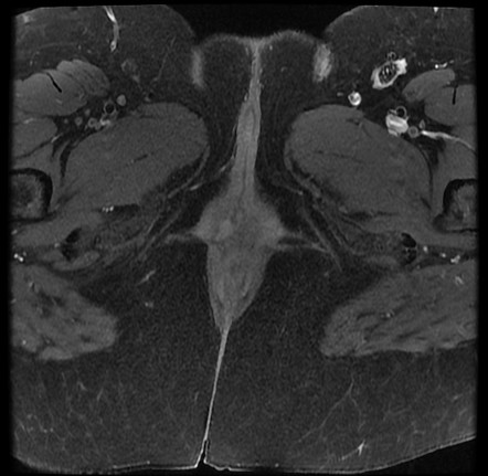 Skene Duct Cyst Image Radiopaedia Org