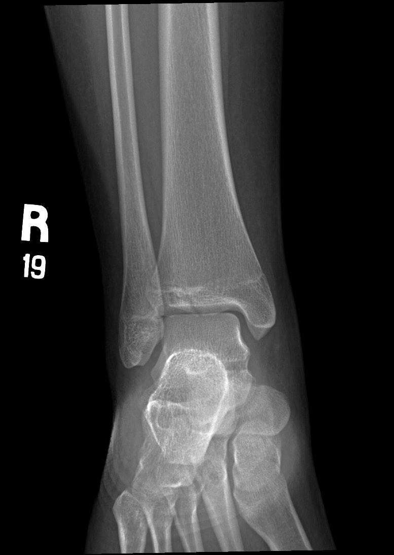 Tillaux fracture | Image | Radiopaedia.org