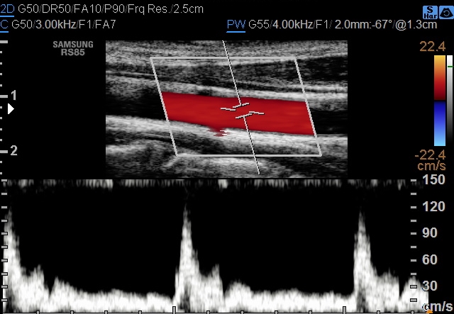 Aliasing artifact (ultrasound) | Image | Radiopaedia.org