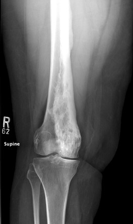 Melorheostosis | Radiology Reference Article | Radiopaedia.org