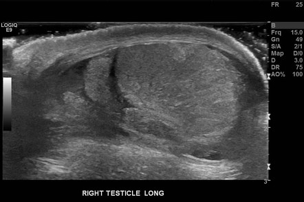 Bilateral testes fractures from blunt scrotal trauma - ScienceDirect