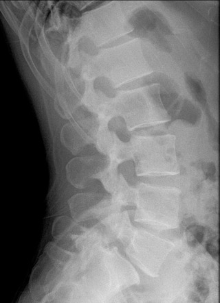 Spondylolisthesis | Radiology Case | Radiopaedia.org