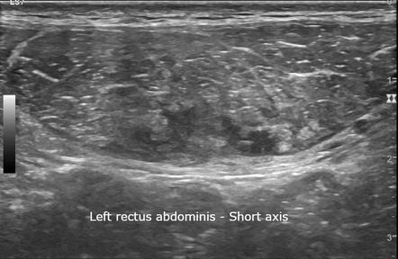 Rectus Abdominis Muscle Ultrasound