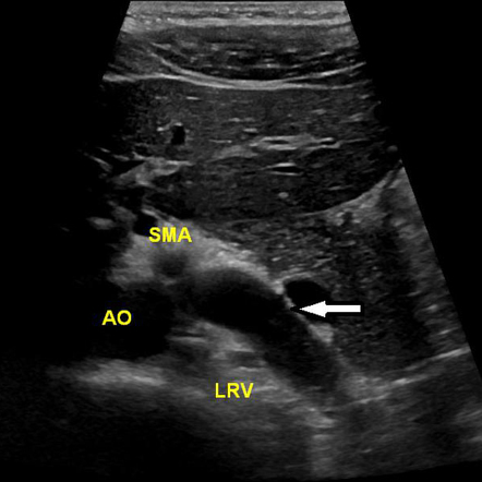 Left testicular varicocele - nutcracker phenomenon | Image ...