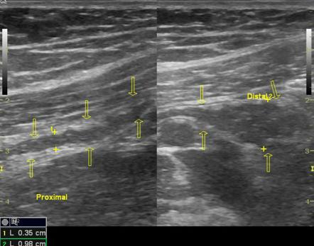 Tip appendicitis | Radiology Case | Radiopaedia.org