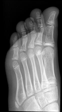 Apophysis of the fifth metatarsal | Image | Radiopaedia.org