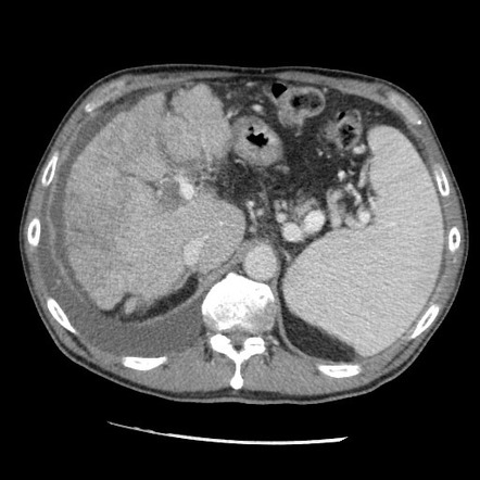 Hepatocellular carcinoma tumor thrombus in the paraumbilical vein ...