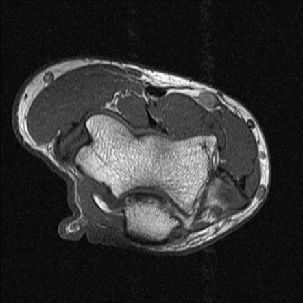 Lateral epicondylitis | Image | Radiopaedia.org