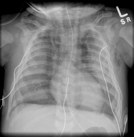 Pneumocystis pneumonia - neonatal | Radiology Case | Radiopaedia.org