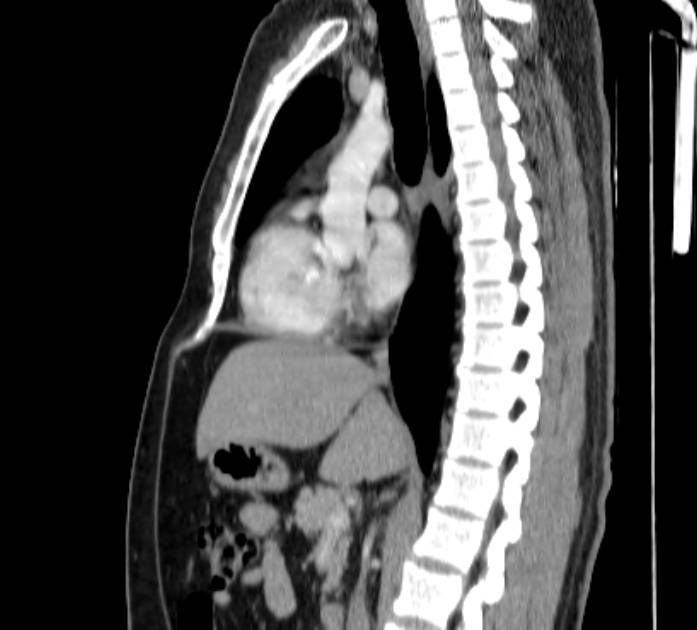 Elongated Hook-like Xiphoid Process | Image | Radiopaedia.org