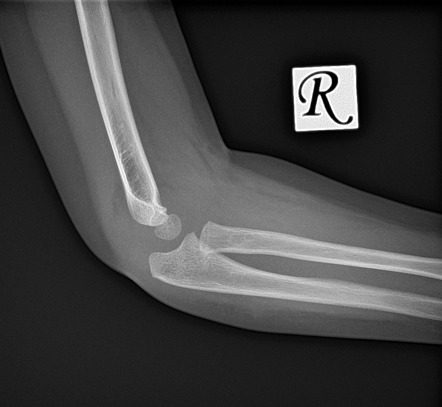 Pediatric Olecranon Fracture Subtle Image Radiopaedia Org