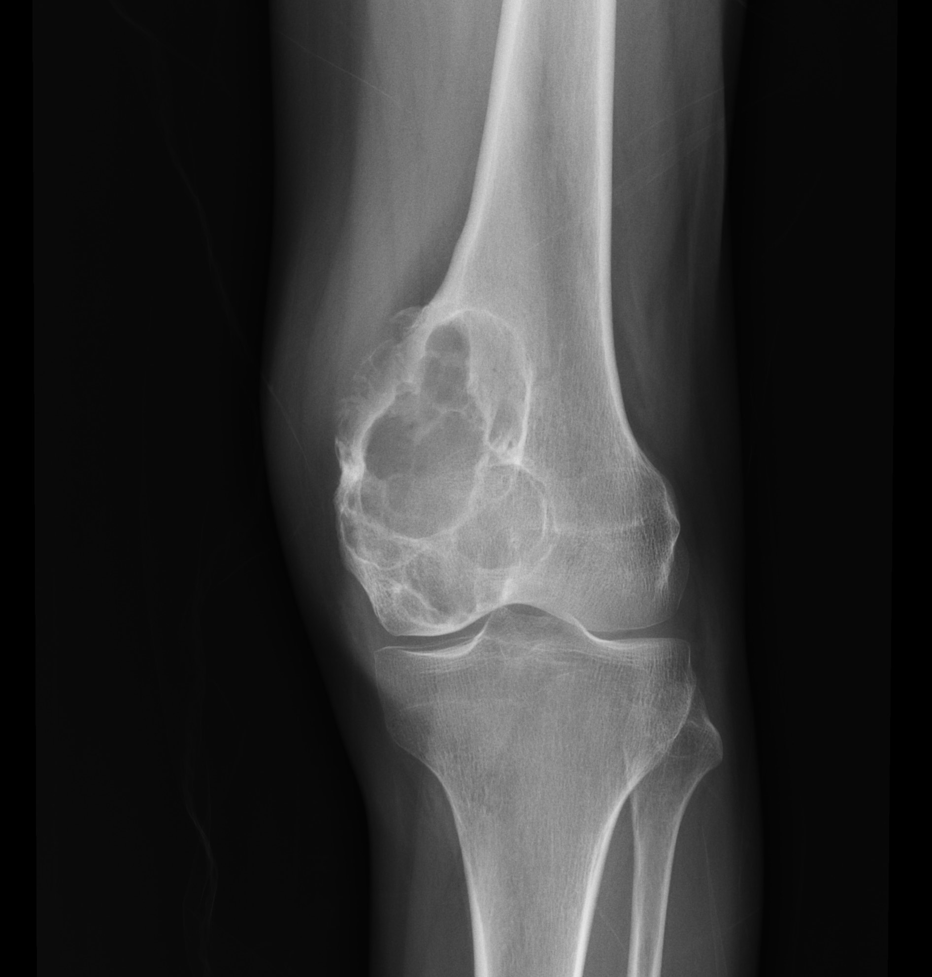 Chondromyxoid fibroma | Image | Radiopaedia.org