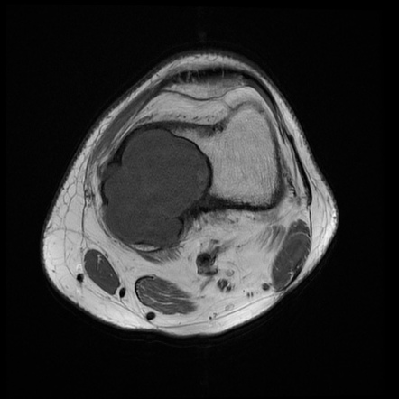 Chondromyxoid fibroma | Image | Radiopaedia.org