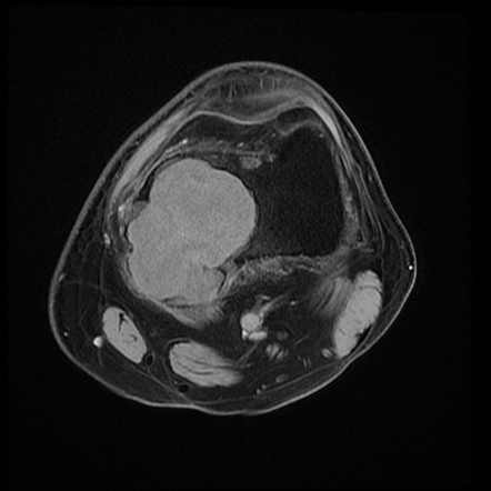 Chondromyxoid fibroma | Image | Radiopaedia.org