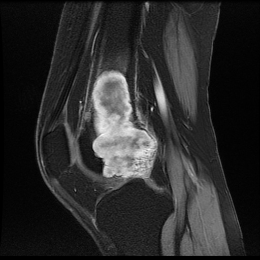 Chondromyxoid Fibroma Image