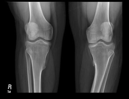 Ellis-van Creveld syndrome | Image | Radiopaedia.org