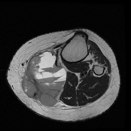 Synovial sarcoma | Radiology Case | Radiopaedia.org