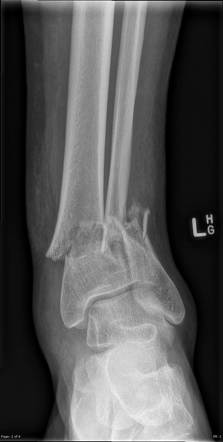 Pilon Fracture | Radiology Case | Radiopaedia.org