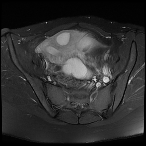 Ovarian endometriomas, hematosalpinx and unicornuate uterus | Image ...