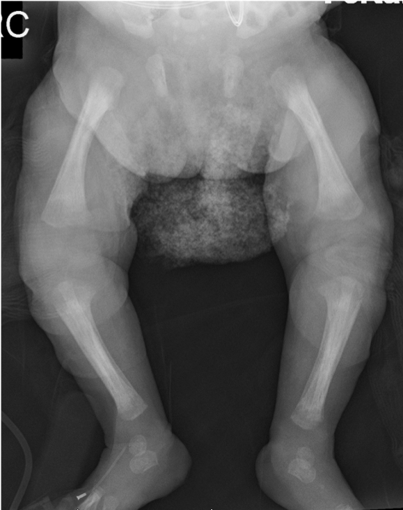 congenital syphilis